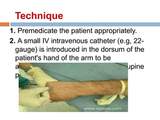 1. Premedicate the patient appropriately.
2. A small IV intravenous catheter (e.g, 22-
gauge) is introduced in the dorsum of the
patient's hand of the arm to be
anesthetized. The patient is in the supine
position.
Technique
 