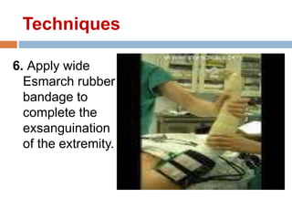 6. Apply wide
Esmarch rubber
bandage to
complete the
exsanguination
of the extremity.
Techniques
 