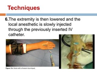 6.The extremity is then lowered and the
local anesthetic is slowly injected
through the previously inserted IV
catheter.
Techniques
 