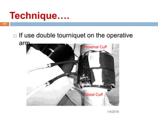  If use double tourniquet on the operative
arm.
Proximal Cuff
Distal Cuff
1/4/2018
117
Technique….
 