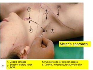 31
1. Cricoid cartilage 4. Puncture site for anterior access
2. Superior thyroid notch 5. Vertical, infraclavicular puncture site
3. SCM
Meier’s approach
 