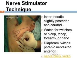 Nerve Stimulator
Technique
 Insert needle
slightly posterior
and caudad.
 Watch for twitches
of bicep, tricep,
forearm, or hand
 Diaphram twitch=
phrenic nerve=too
anterior.
 nerve block vedio
1/4/2018
33
 