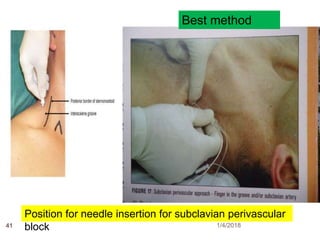 41
Position for needle insertion for subclavian perivascular
block
Best method
1/4/2018
 