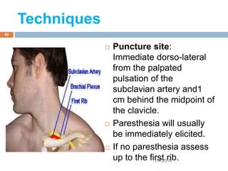  Puncture site:
Immediate dorso-lateral
from the palpated
pulsation of the
subclavian artery and1
cm behind the midpoint of
the clavicle.
 Paresthesia will usually
be immediately elicited.
 If no paresthesia assess
up to the first rib.
Techniques
1/4/2018
42
 