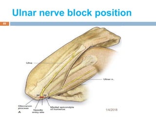 Ulnar nerve block position
1/4/2018
89
 