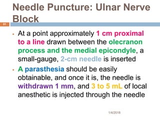 Needle Puncture: Ulnar Nerve
Block
 At a point approximately 1 cm proximal
to a line drawn between the olecranon
process and the medial epicondyle, a
small-gauge, 2-cm needle is inserted
 A parasthesia should be easily
obtainable, and once it is, the needle is
withdrawn 1 mm, and 3 to 5 mL of local
anesthetic is injected through the needle
1/4/2018
91
 
