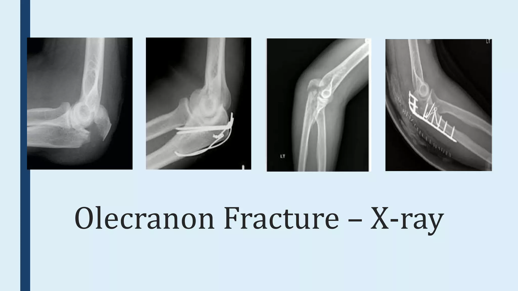 upper-limb-fractures-pptx