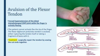 Upper limb fractures | PPTX