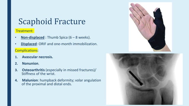 Upper Limb Fractures Ppt Upper Limb Fractures Ppt