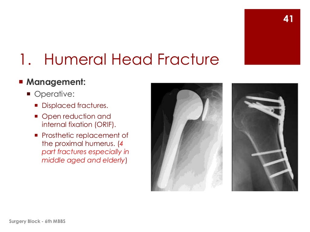 Fractures and Dislocations of Upper Limb