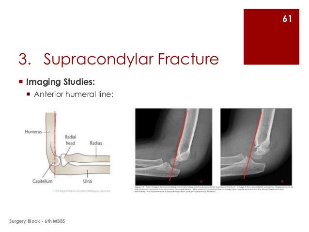 Fractures and Dislocations of Upper Limb