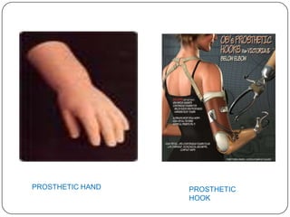 Wrist Disarticulation