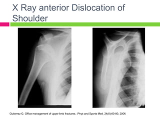 Upper_limb_injuries_x_raysjBqbbsbdhns.ppt