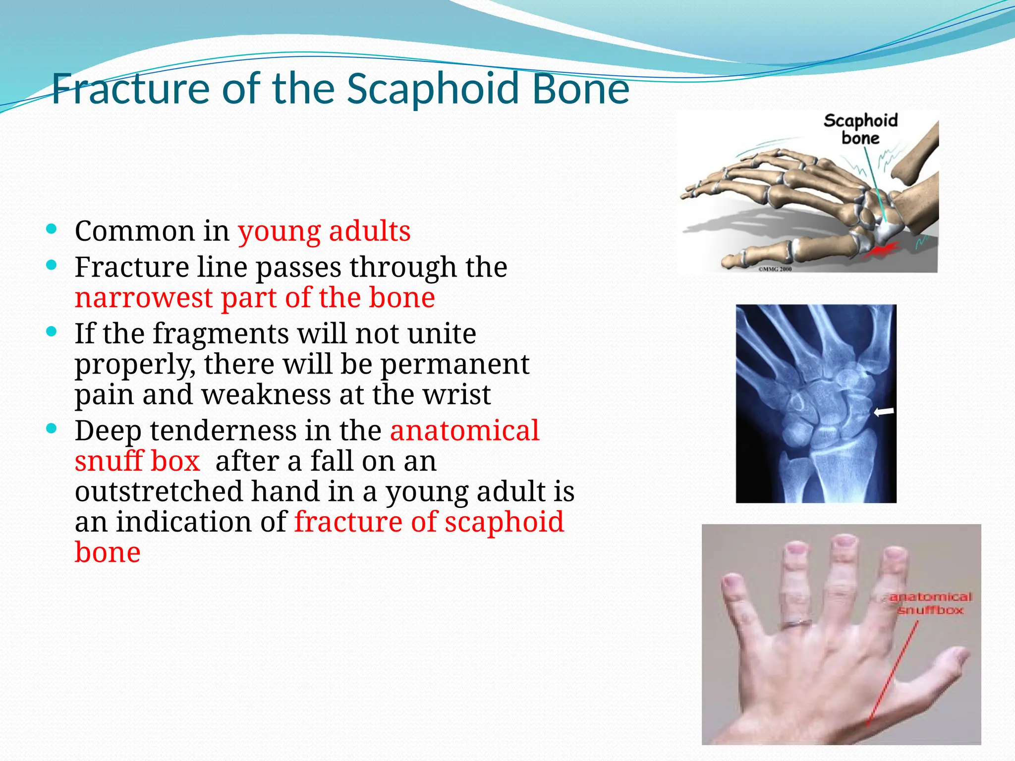 Fracture of the Scaphoid Bone
 Common in young adults
 Fracture line passes through the
narrowest part of the bone
 If the fragments will not unite
properly, there will be permanent
pain and weakness at the wrist
 Deep tenderness in the anatomical
snuff box after a fall on an
outstretched hand in a young adult is
an indication of fracture of scaphoid
bone
 