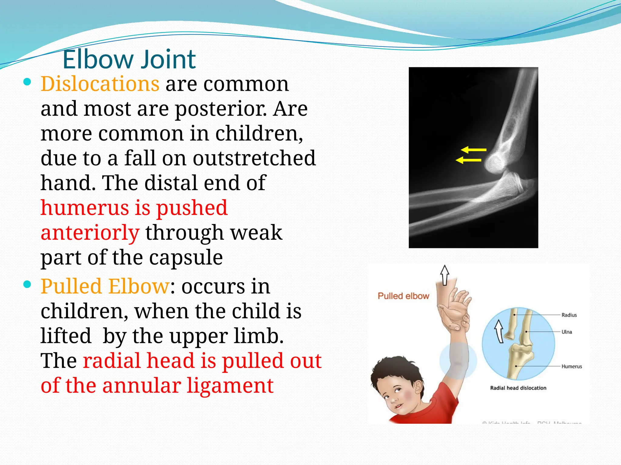 Elbow Joint
 Dislocations are common
and most are posterior. Are
more common in children,
due to a fall on outstretched
hand. The distal end of
humerus is pushed
anteriorly through weak
part of the capsule
 Pulled Elbow: occurs in
children, when the child is
lifted by the upper limb.
The radial head is pulled out
of the annular ligament
 