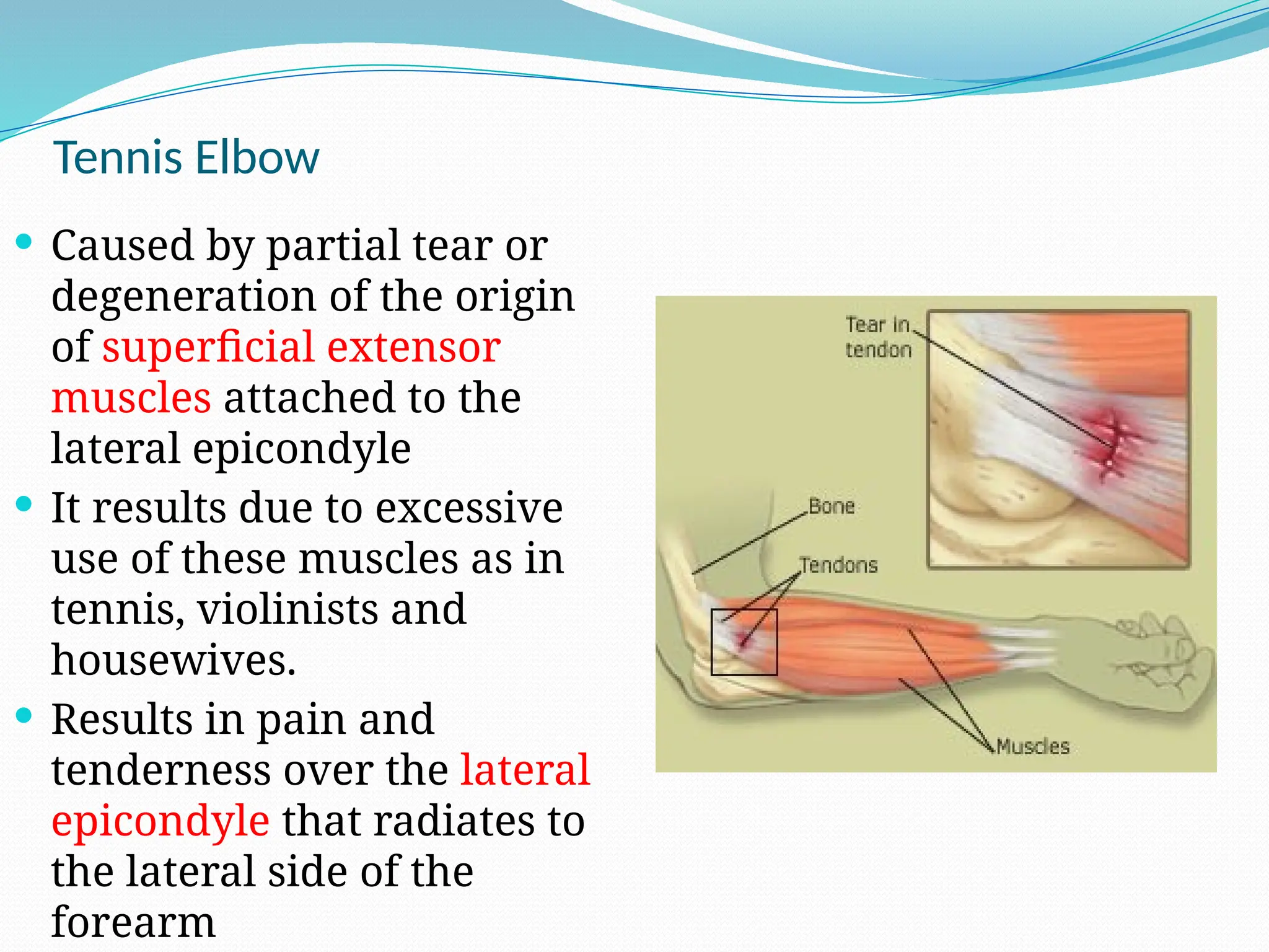 Tennis Elbow
 Caused by partial tear or
degeneration of the origin
of superficial extensor
muscles attached to the
lateral epicondyle
 It results due to excessive
use of these muscles as in
tennis, violinists and
housewives.
 Results in pain and
tenderness over the lateral
epicondyle that radiates to
the lateral side of the
forearm
 