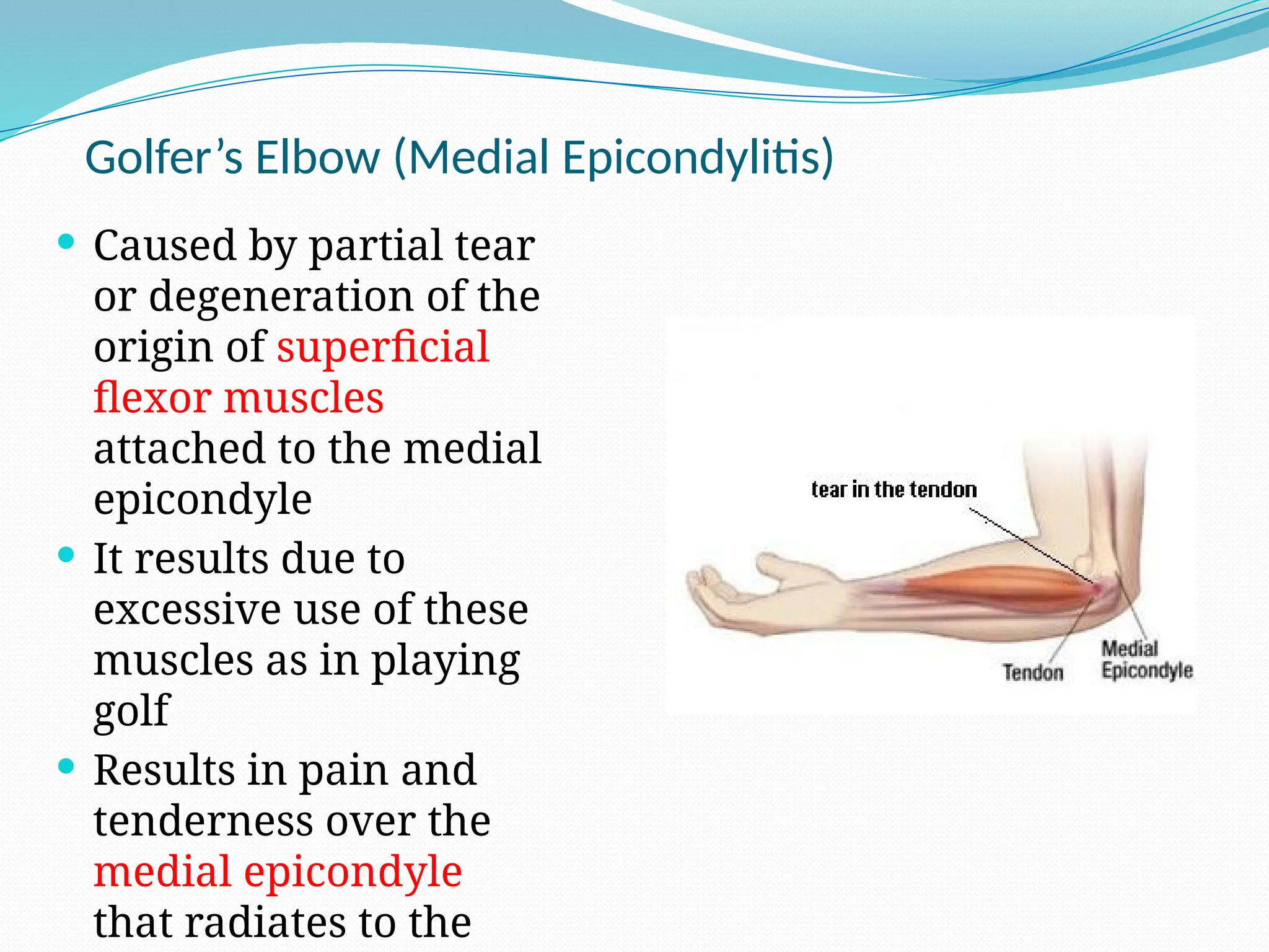 Golfer’s Elbow (Medial Epicondylitis)
 Caused by partial tear
or degeneration of the
origin of superficial
flexor muscles
attached to the medial
epicondyle
 It results due to
excessive use of these
muscles as in playing
golf
 Results in pain and
tenderness over the
medial epicondyle
that radiates to the
 