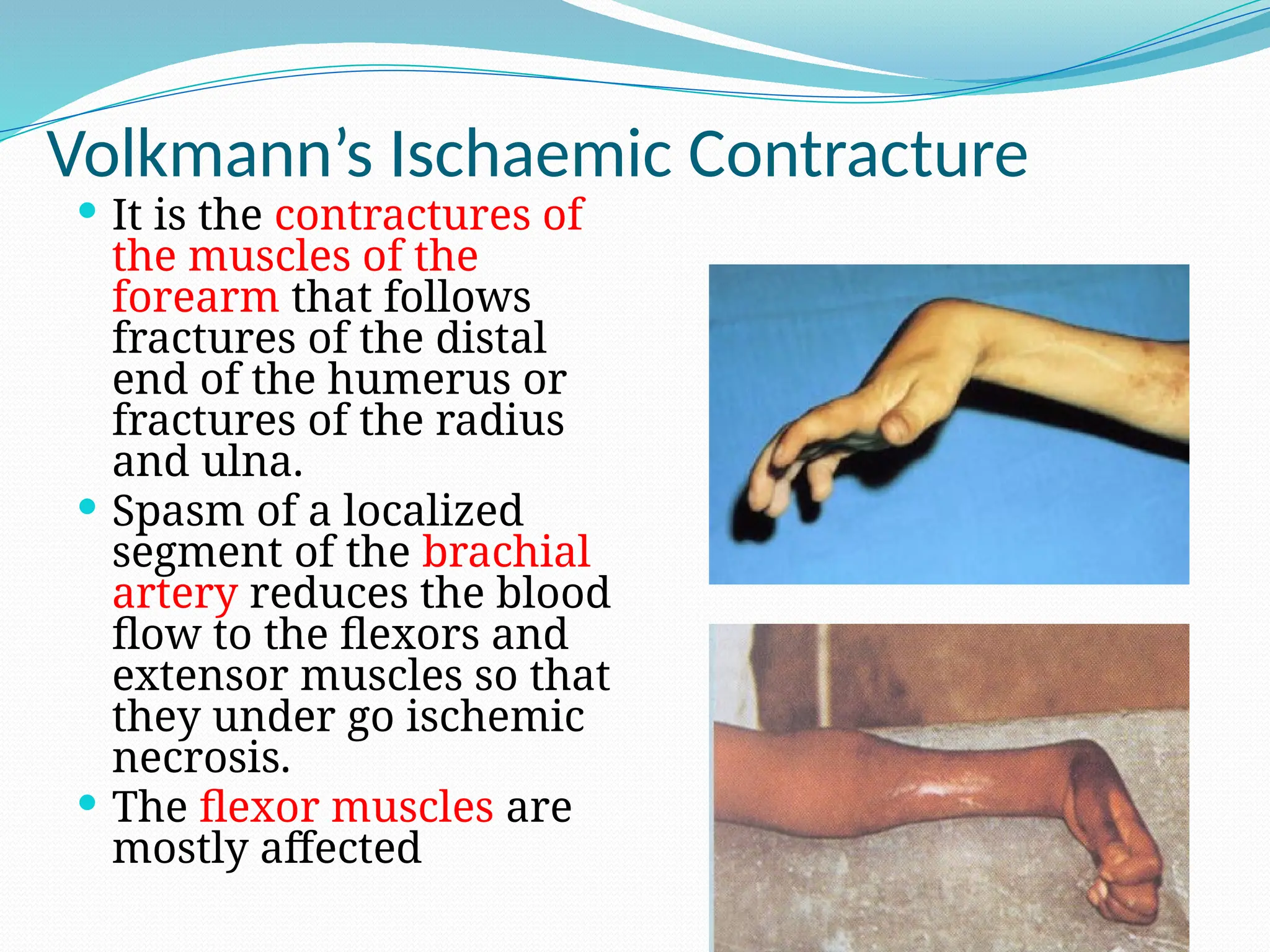 Volkmann’s Ischaemic Contracture
 It is the contractures of
the muscles of the
forearm that follows
fractures of the distal
end of the humerus or
fractures of the radius
and ulna.
 Spasm of a localized
segment of the brachial
artery reduces the blood
flow to the flexors and
extensor muscles so that
they under go ischemic
necrosis.
 The flexor muscles are
mostly affected
 