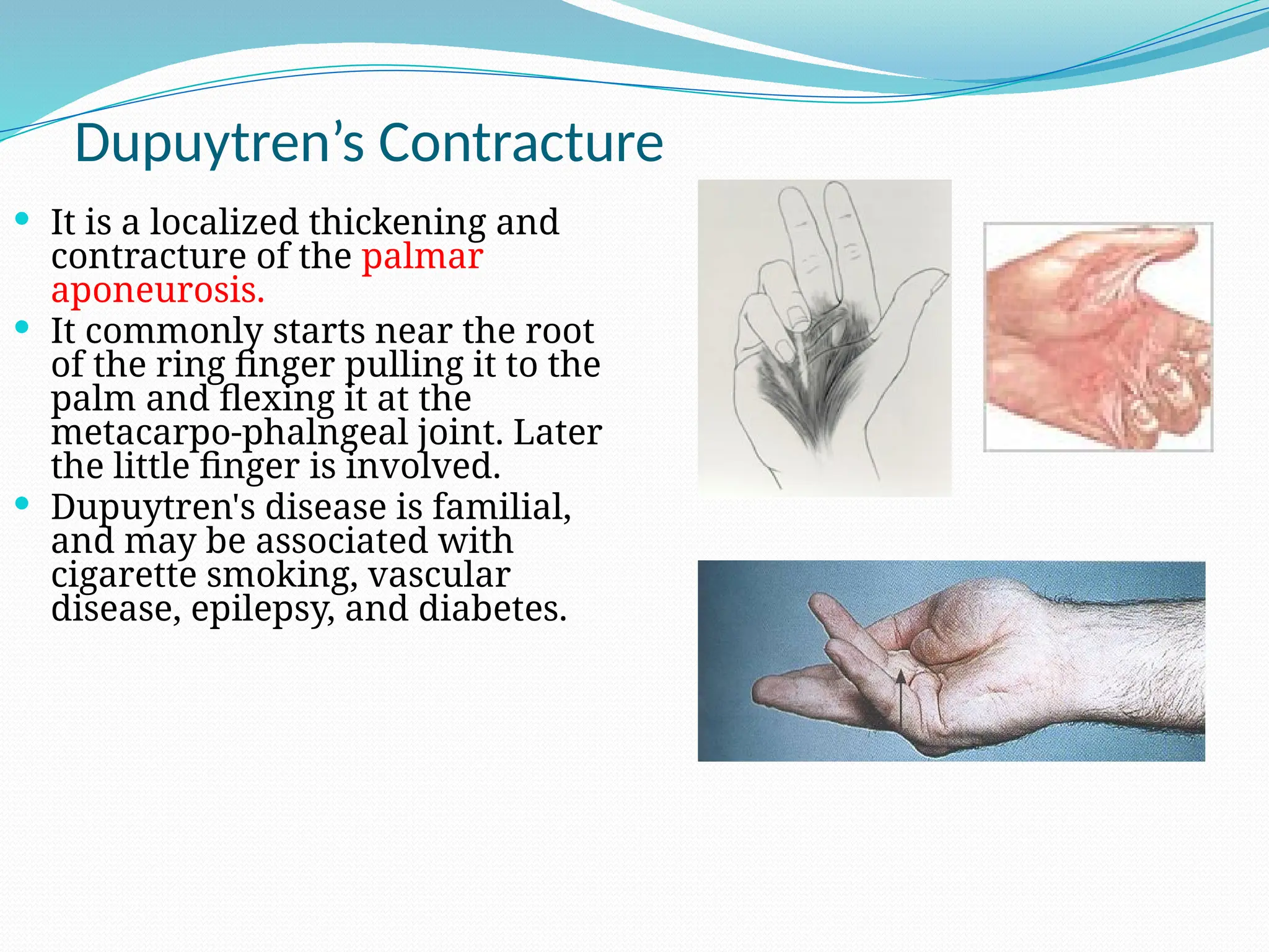 Dupuytren’s Contracture
 It is a localized thickening and
contracture of the palmar
aponeurosis.
 It commonly starts near the root
of the ring finger pulling it to the
palm and flexing it at the
metacarpo-phalngeal joint. Later
the little finger is involved.
 Dupuytren's disease is familial,
and may be associated with
cigarette smoking, vascular
disease, epilepsy, and diabetes.
 