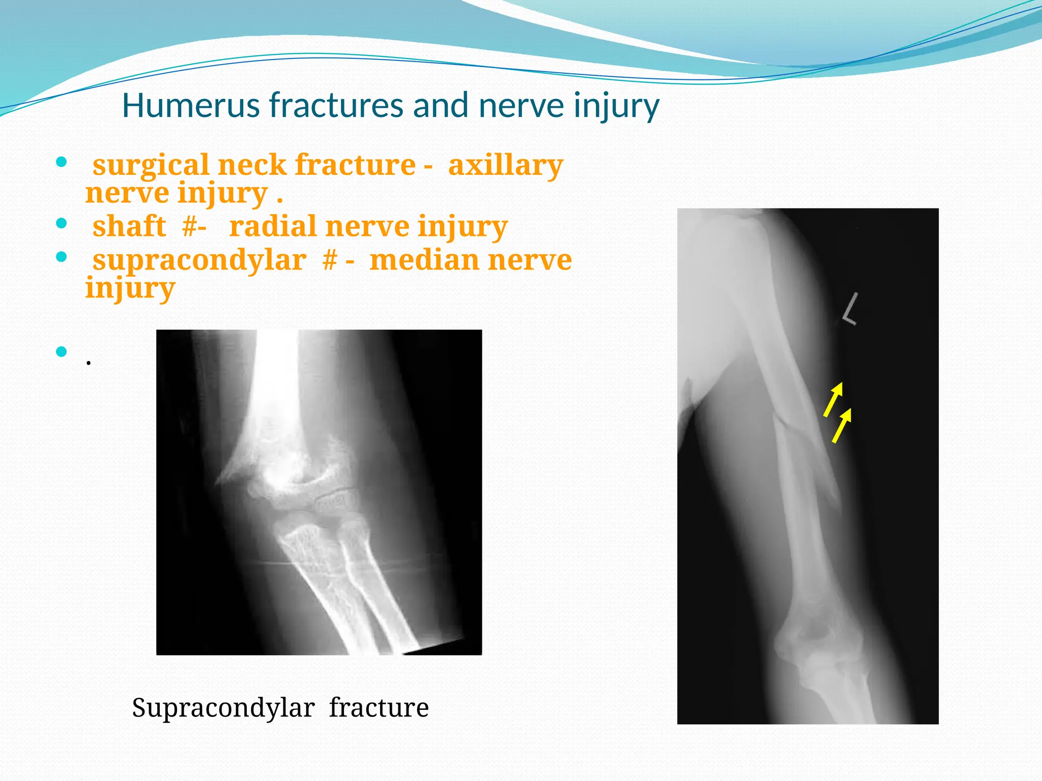 Humerus fractures and nerve injury
 surgical neck fracture - axillary
nerve injury .
 shaft #- radial nerve injury
 supracondylar # - median nerve
injury
 .
Supracondylar fracture
 