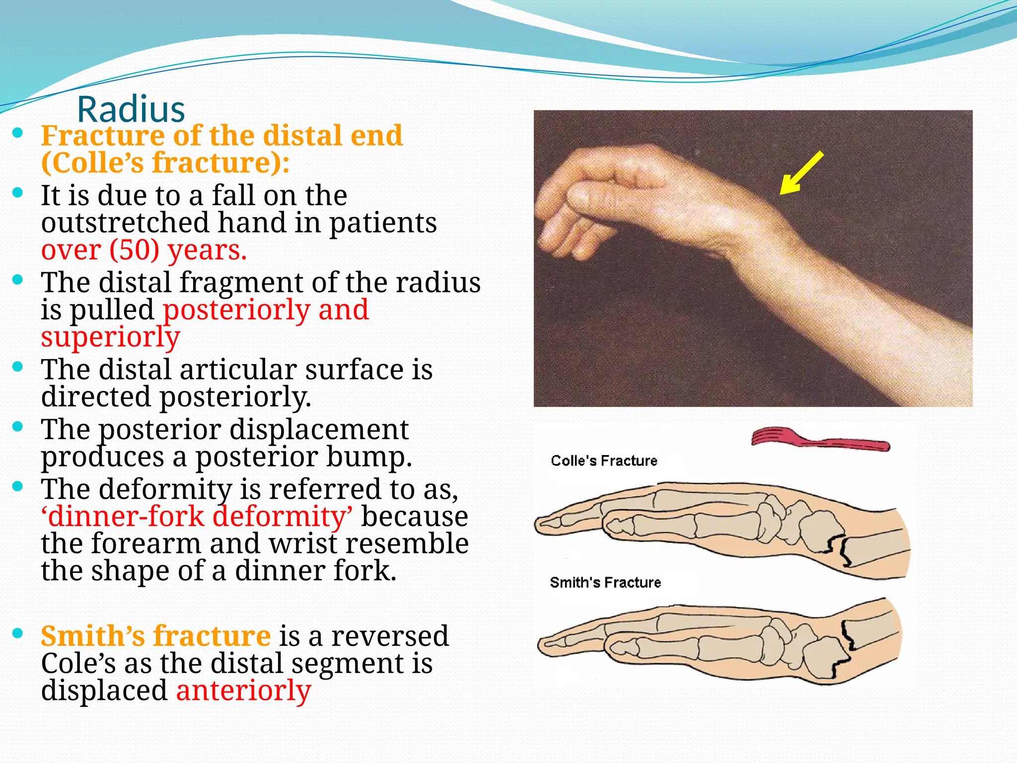 Radius
 Fracture of the distal end
(Colle’s fracture):
 It is due to a fall on the
outstretched hand in patients
over (50) years.
 The distal fragment of the radius
is pulled posteriorly and
superiorly
 The distal articular surface is
directed posteriorly.
 The posterior displacement
produces a posterior bump.
 The deformity is referred to as,
‘dinner-fork deformity’ because
the forearm and wrist resemble
the shape of a dinner fork.
 Smith’s fracture is a reversed
Cole’s as the distal segment is
displaced anteriorly
 