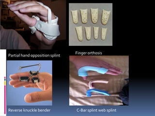 Obs Splint Upper limb orthosis | PPTX
