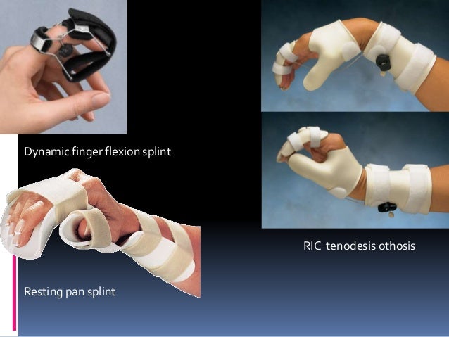 casting upper limb This review found that there is insufficient high-quality evidence to evaluate the effectiveness of upper limb casting for children or adults with central nervous system motor disorders despite some limitations in the search and in the reporting of the review methods, the authors' conclusions . casting upper limb This review found that there is insufficient high-quality evidence to evaluate the effectiveness of upper limb casting for children or adults with central nervous system motor disorders despite some limitations in the search and in the reporting of the review methods, the authors' conclusions .