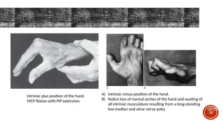 upper limb orthosis biomechanics.pptx ... | PPTX