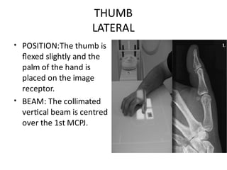 Lateral Thumb Rotation Upper Limb Plain Radiology: DR. MITESH J. PATEL(M.S ORTHO) | PDF