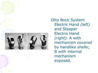 Otto Bock System
Electric Hand (left)
and Steeper
Electric Hand
(right). A with
mechanism covered
by handlike shells;
B with internal
mechanism
exposed.
 