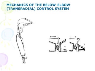 MECHANICS OF THE BELOW-ELBOW
(TRANSRADIAL) CONTROL SYSTEM
 