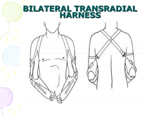 BILATERAL TRANSRADIALBILATERAL TRANSRADIAL
HARNESSHARNESS
 