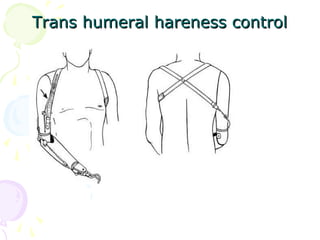 Trans humeral hareness controlTrans humeral hareness control
 