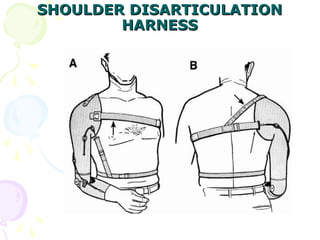 SHOULDER DISARTICULATIONSHOULDER DISARTICULATION
HARNESSHARNESS
 