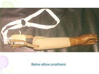 Below elbow prosthesis
 