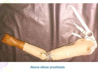 Above elbow prosthesis
 
