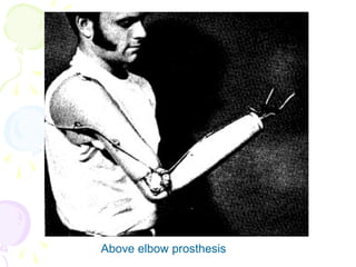 Above elbow prosthesis
 