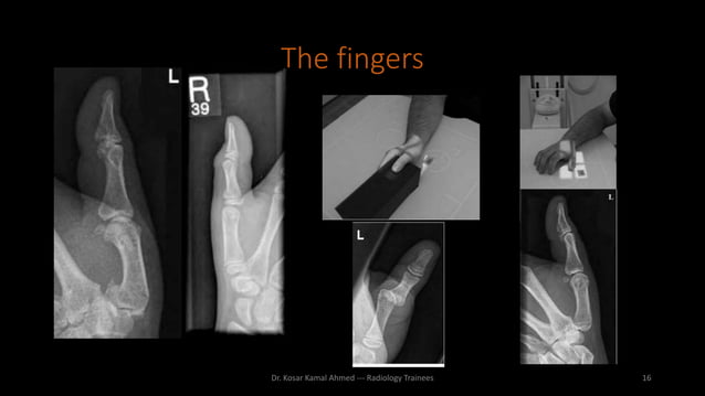 Upper limb radiography | PPTX