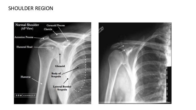 Upper limb radiology