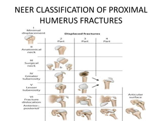 Nehr Classification upper limb trauma.pptx