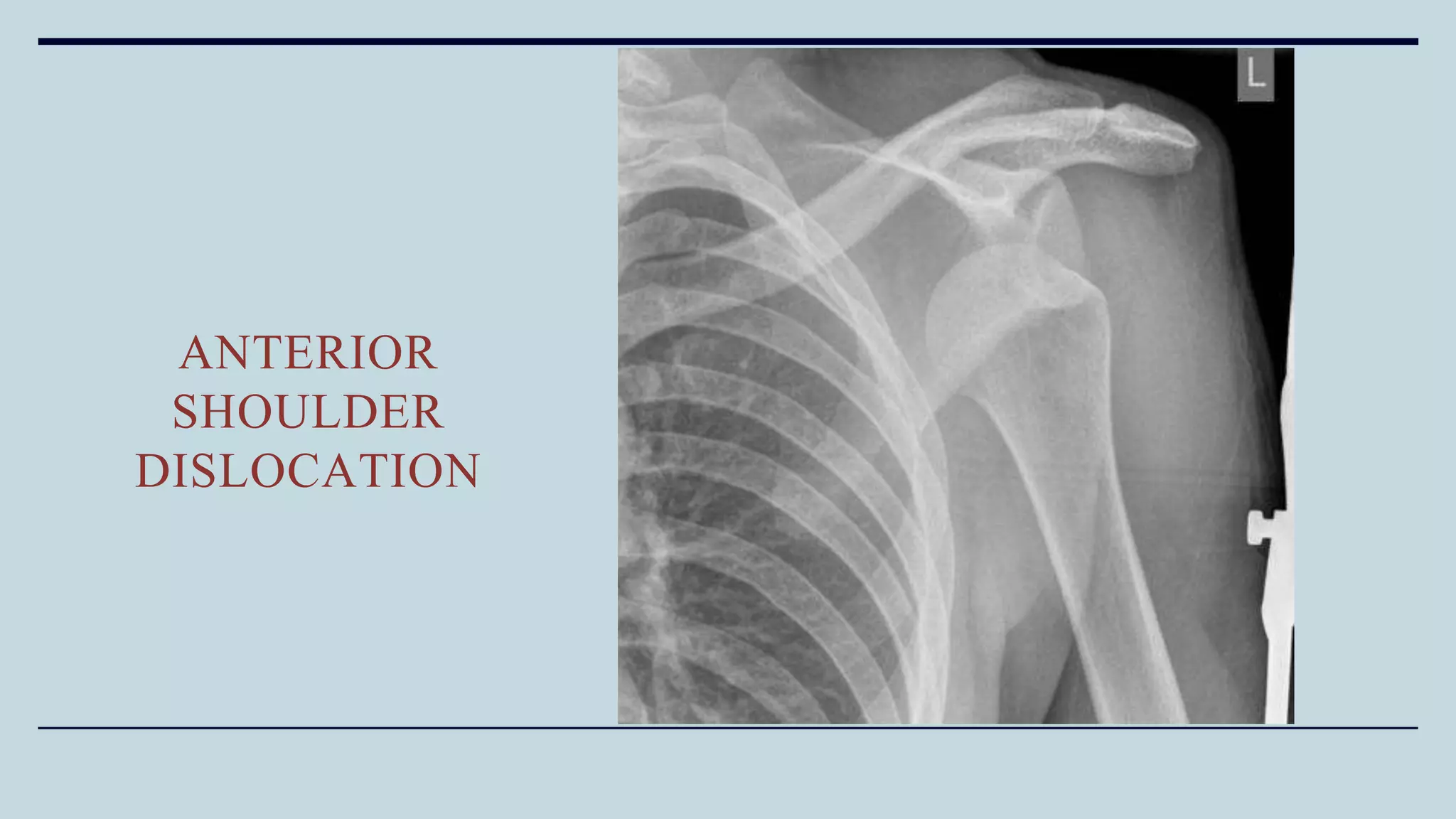 ANTERIOR
SHOULDER
DISLOCATION
 