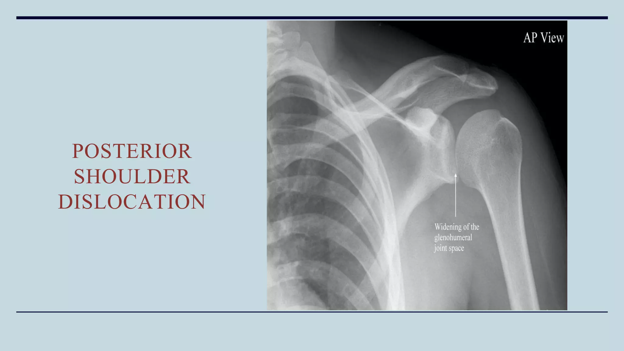 POSTERIOR
SHOULDER
DISLOCATION
 