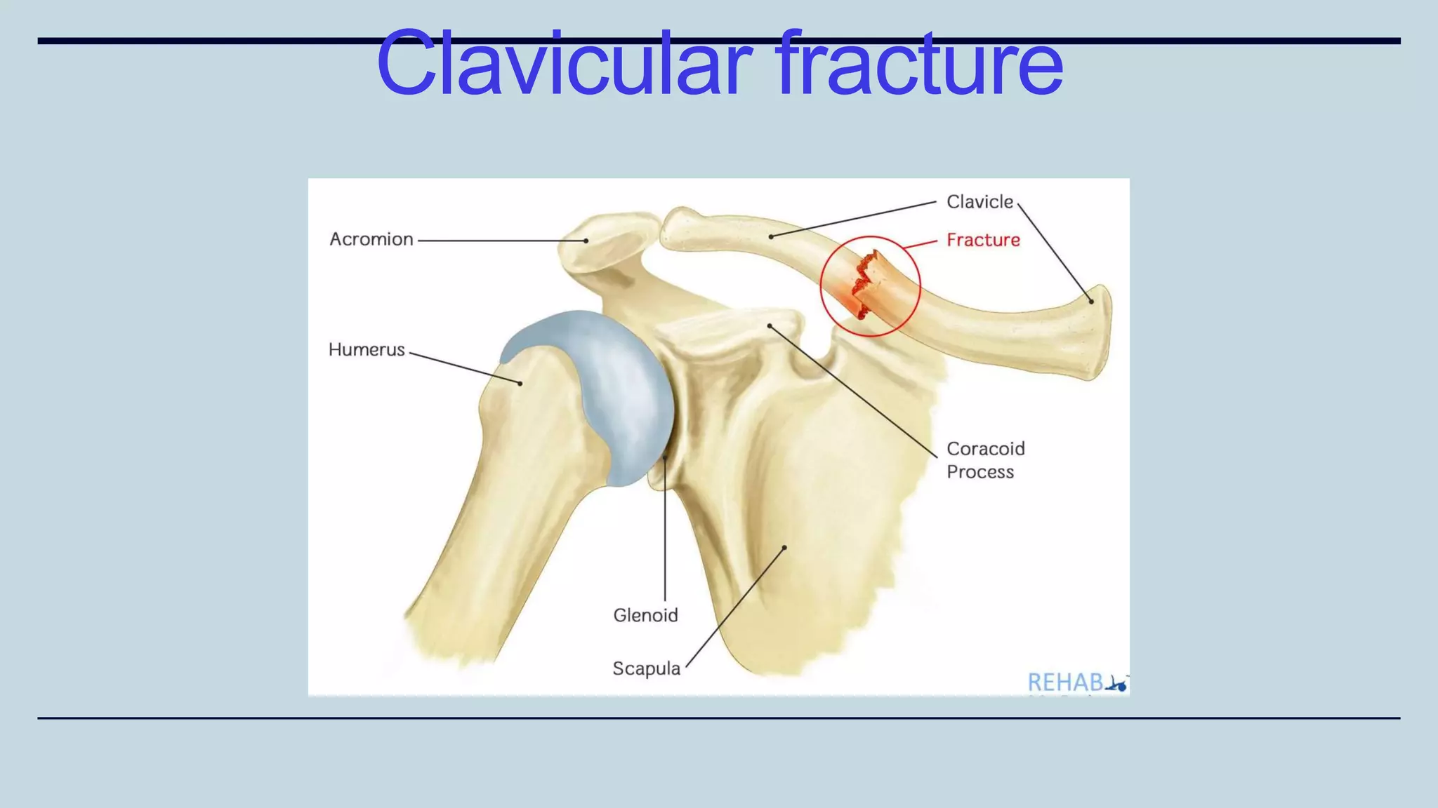 Clavicular fracture
 