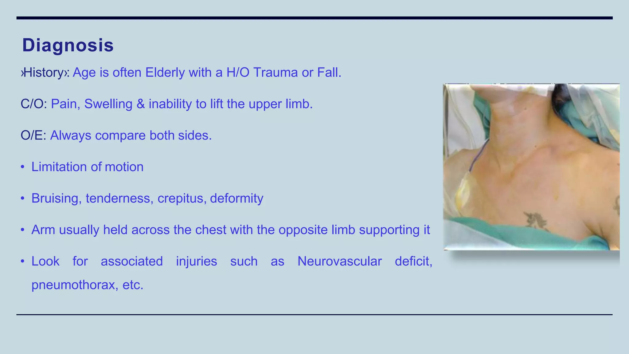 ›History›: Age is often Elderly with a H/O Trauma or Fall.
C/O: Pain, Swelling & inability to lift the upper limb.
O/E: Always compare both sides.
• Limitation of motion
• Bruising, tenderness, crepitus, deformity
• Arm usually held across the chest with the opposite limb supporting it
• Look for associated injuries such as Neurovascular deficit,
pneumothorax, etc.
Diagnosis
 