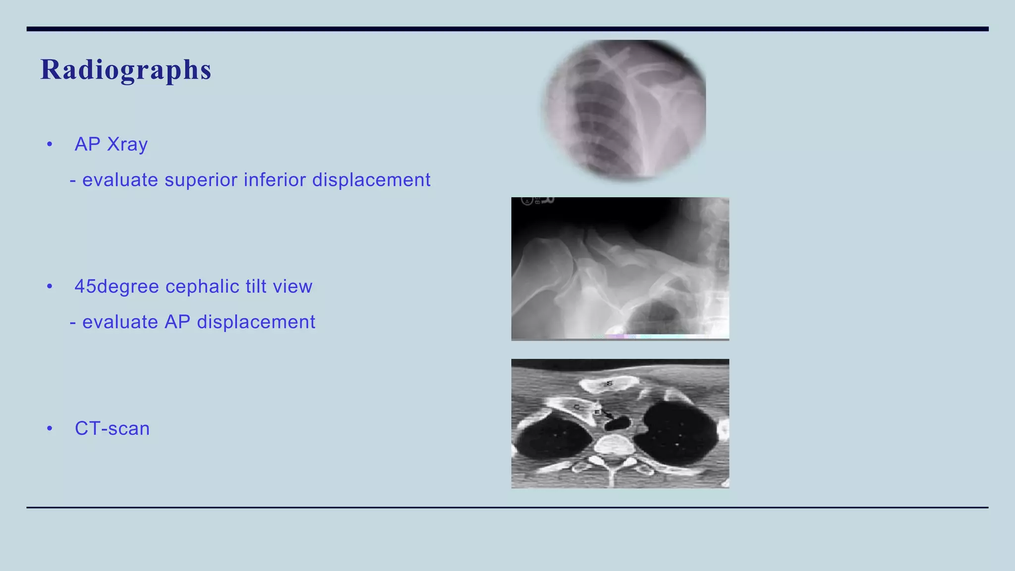 • AP Xray
- evaluate superior inferior displacement
• 45degree cephalic tilt view
- evaluate AP displacement
• CT-scan
Radiographs
 