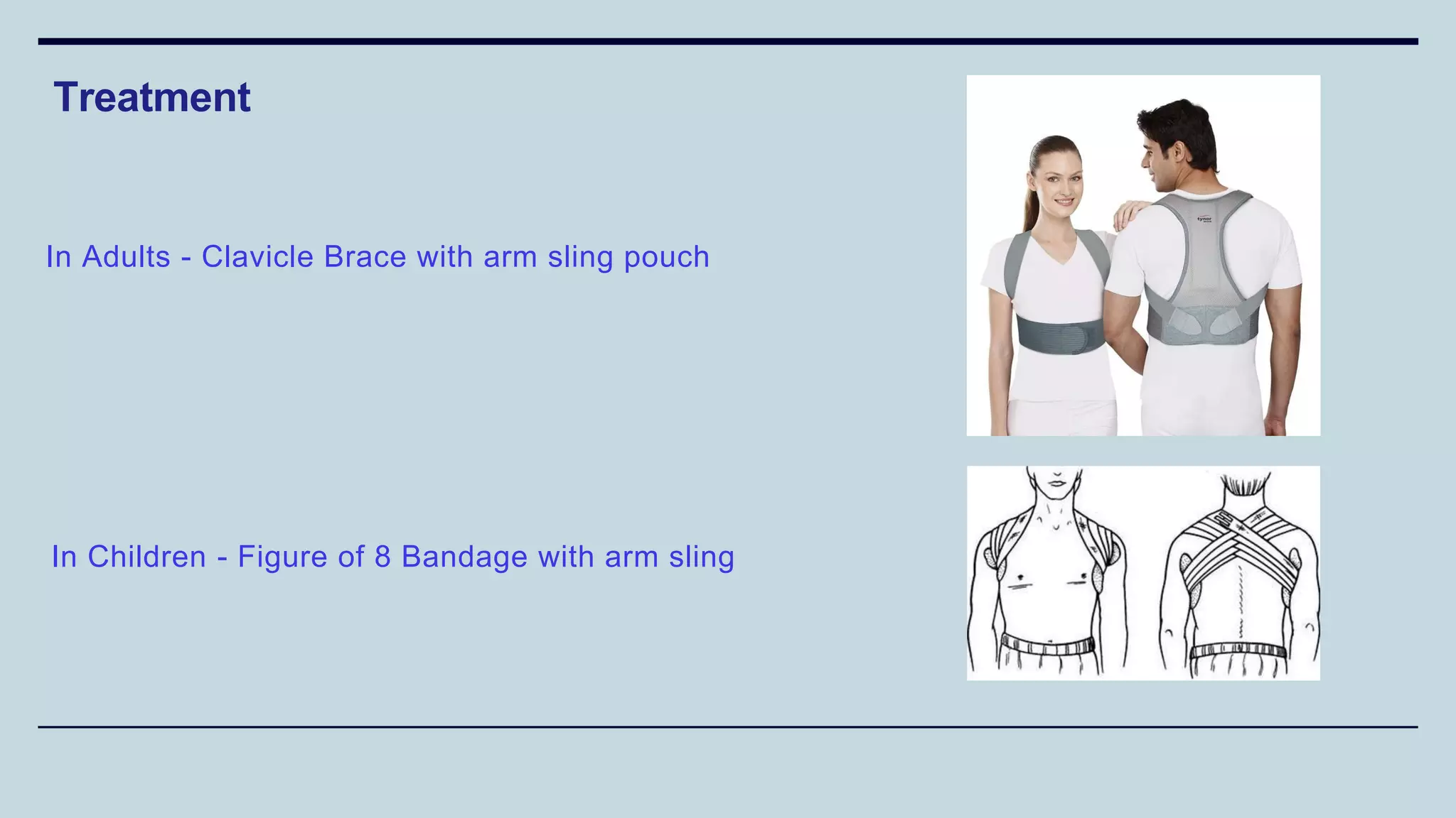 Treatment
In Adults - Clavicle Brace with arm sling pouch
In Children - Figure of 8 Bandage with arm sling
 