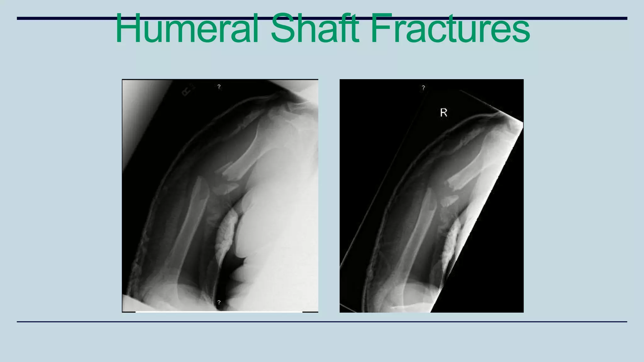 Humeral Shaft Fractures
 