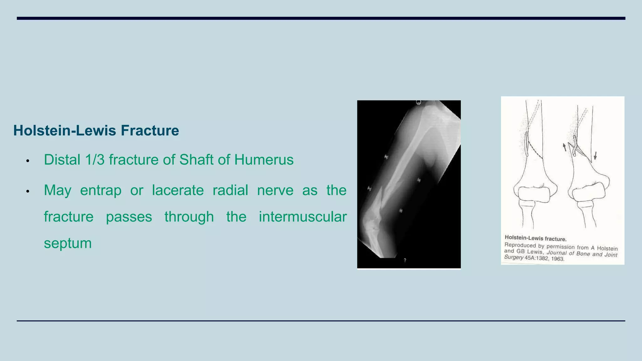 Holstein-Lewis Fracture
• Distal 1/3 fracture of Shaft of Humerus
• May entrap or lacerate radial nerve as the
fracture passes through the intermuscular
septum
 