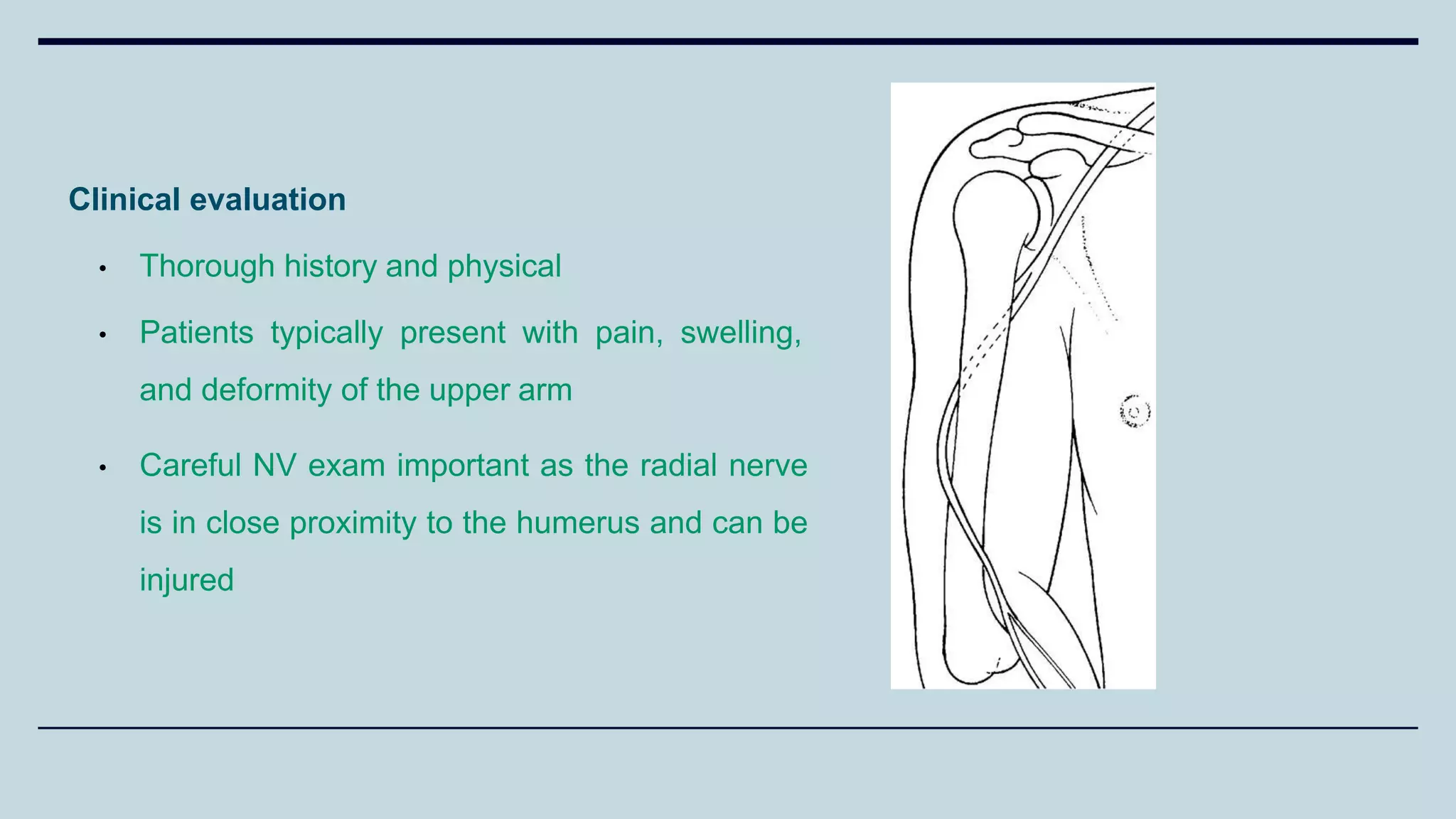 Clinical evaluation
• Thorough history and physical
• Patients typically present with pain, swelling,
and deformity of the upper arm
• Careful NV exam important as the radial nerve
is in close proximity to the humerus and can be
injured
 