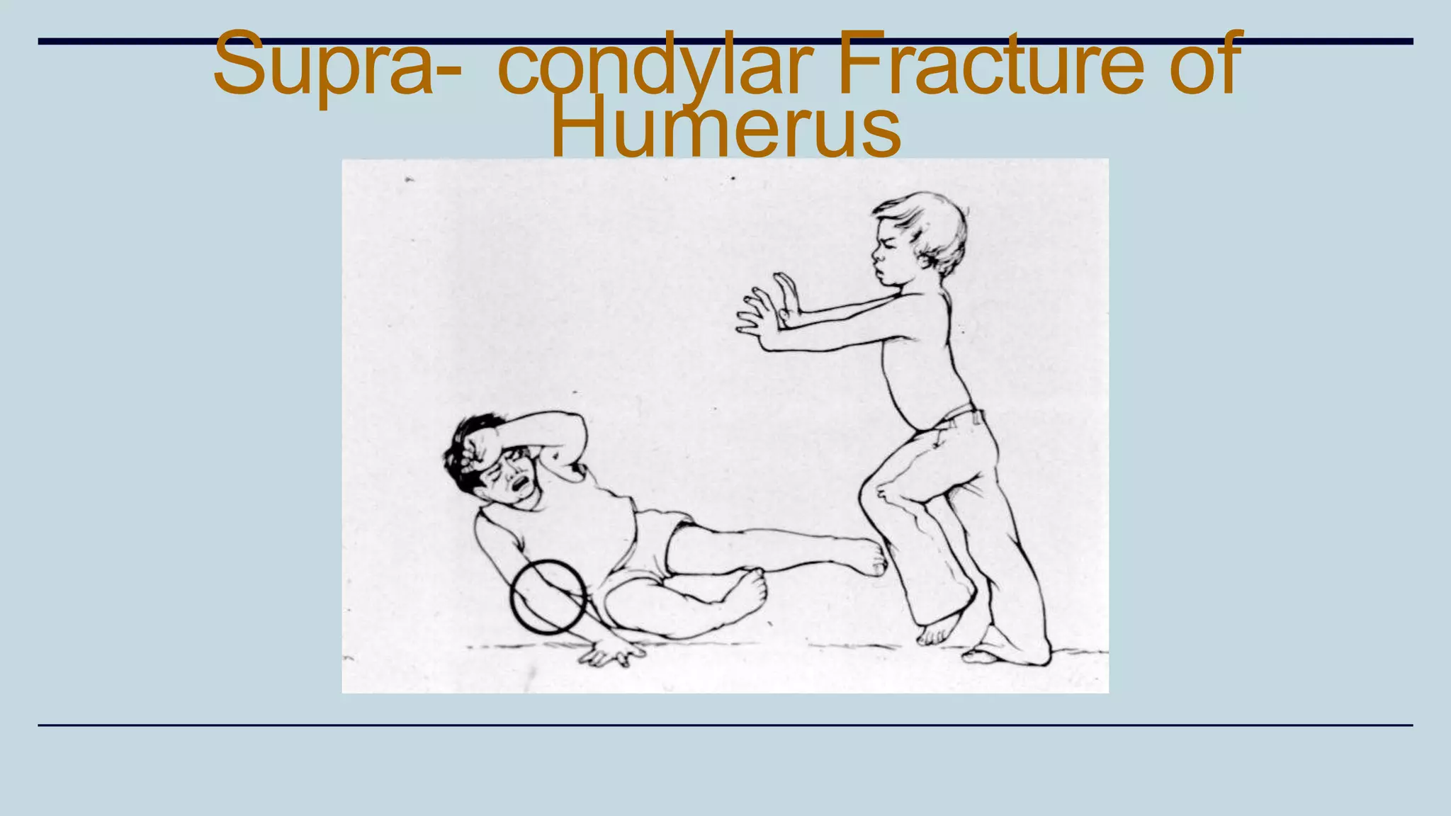 Supra- condylar Fracture of
Humerus
 